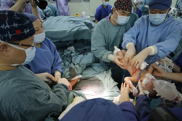 Medical team successfully separates conjoined twins